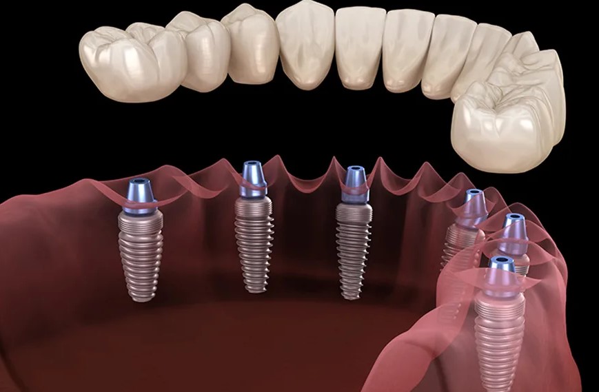 Система дентальных имплантатов: как они работают