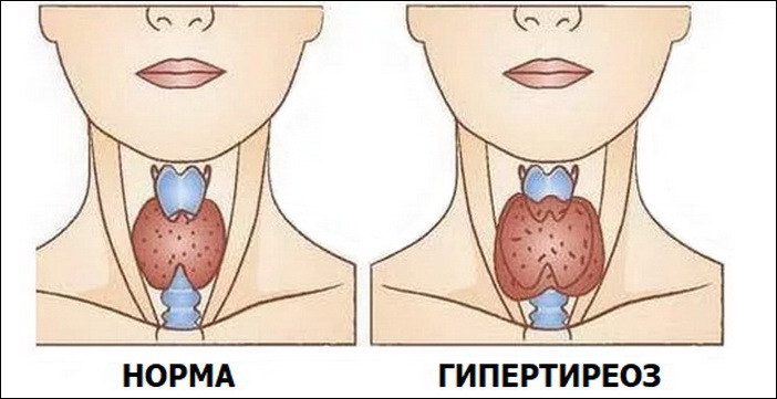 Гипертиреоз – причины развития, симптомы, методы устранения