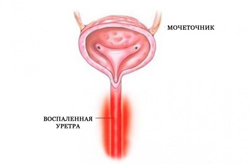 Признаки и симптомы уретрита