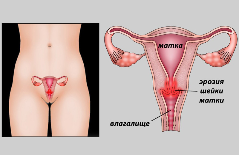 Что такое и чем опасна эрозия шейки матки
