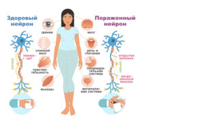 Рассеянный склероз - что за заболевание, и особенности его протекания