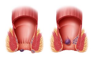Методы лечения острого геморроя