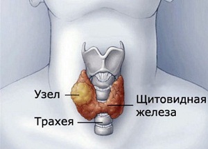 Патологическое разрастание тканей в органе или узлы в щитовидной железе: чем опасны и как лечат образования методы лечения узлов на щитовидной железе