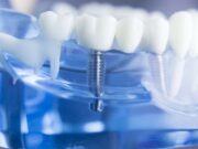 Имплантация зубов в «Виодент»