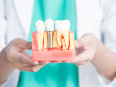 Имплантация зубов: важные моменты