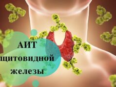 Аутоиммунный тиреоидит: причины, симптомы и лечение