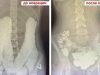 Подмосковные врачи спасли девушку с редкой аномалией кишечника