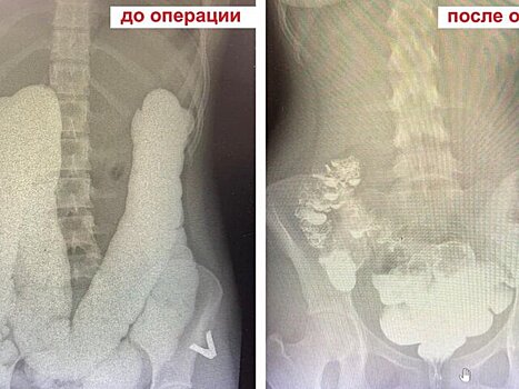 Подмосковные врачи спасли девушку с редкой аномалией кишечника