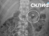 Врачи «Склифа» показали, что доставали из пациентов в 2025 году