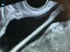 В Красногорске врачи достали из мочевого пузыря женщины косметический карандаш