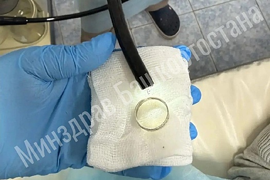 В Уфе врачи успешно извлекли кольцо из пищевода пенсионерки